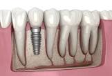 Implant & General Dentistry of Northern Colorado